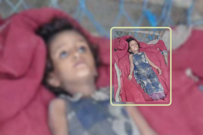 وفاة مأساوية لطفلة نازحة تجسد كارثة الجوع في مناطق الحوثيين
